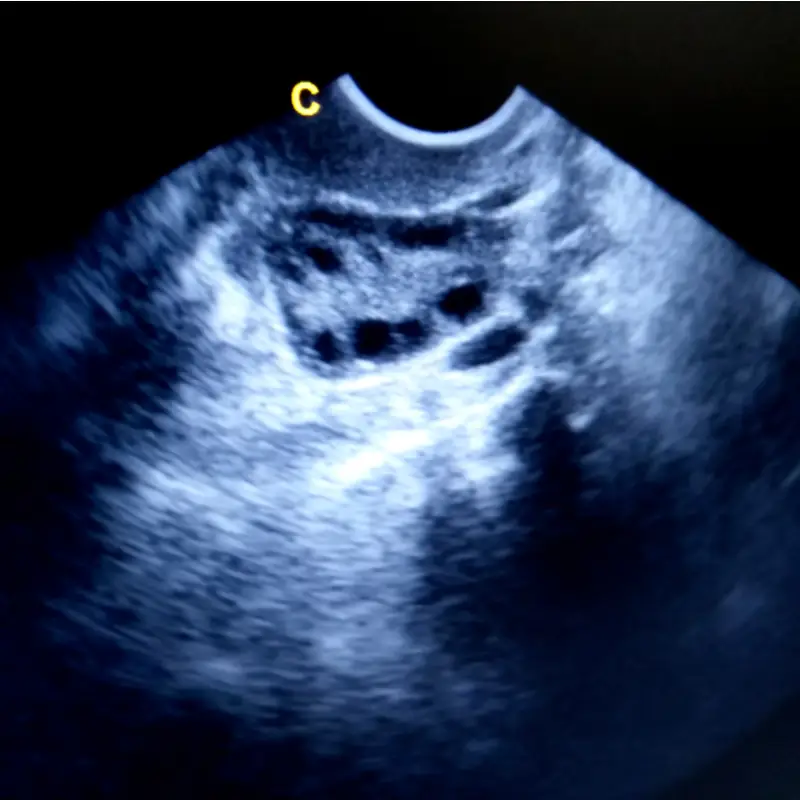 PCOS cysts on ultrasound picture