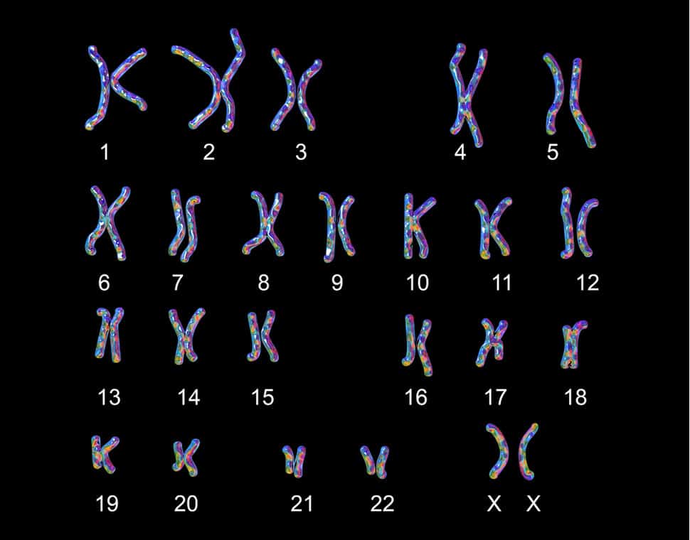 Chromosomes from a prenatal genetic test