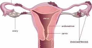 endometriosis on uterus causing female infertility